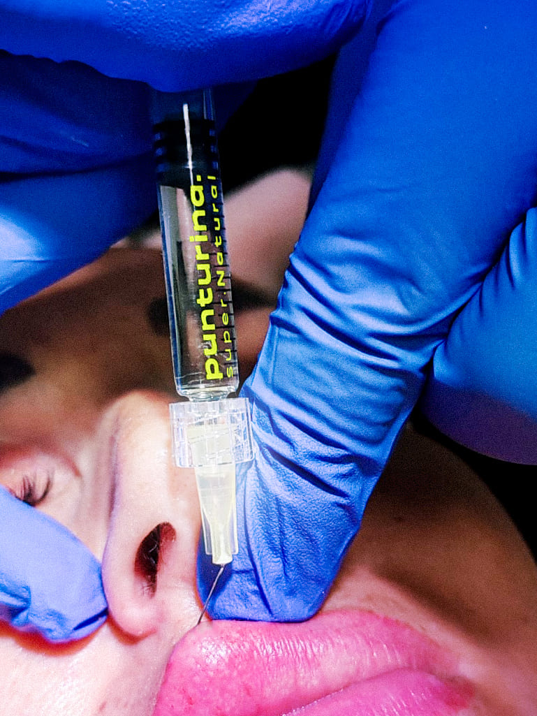 Trattamento filler labbra nell'ambito di un percorso di medicina estetica funzionale su paziente di 35 anni