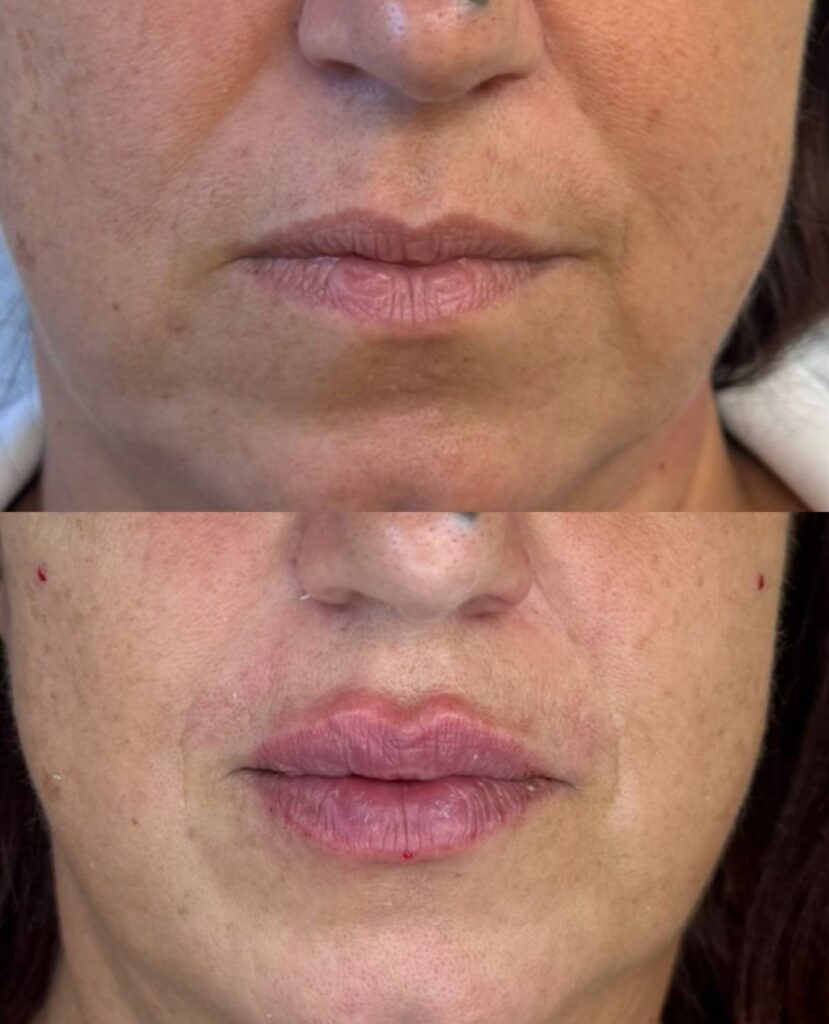 Prima/Dopo risultato filler labbra