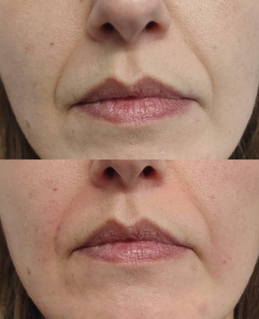 Prima/Dopo risultato filler rughe della marionetta naso-labiali nasogeniene