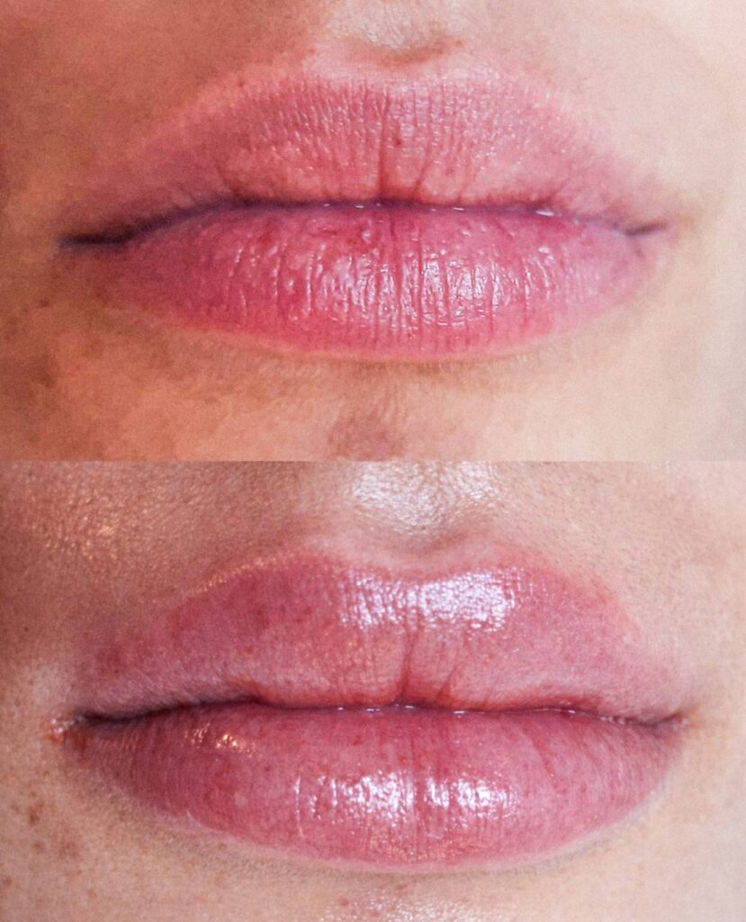 Prima/Dopo risultato filler labbra