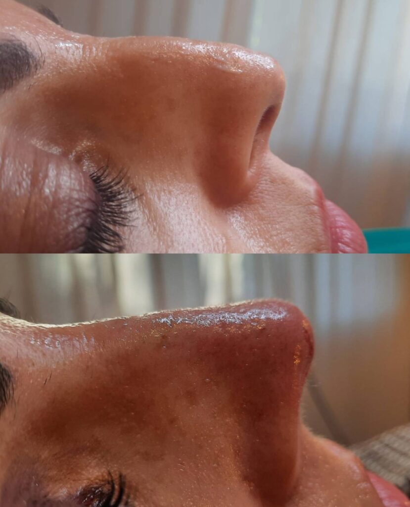 Prima/Dopo risultato rinofiller